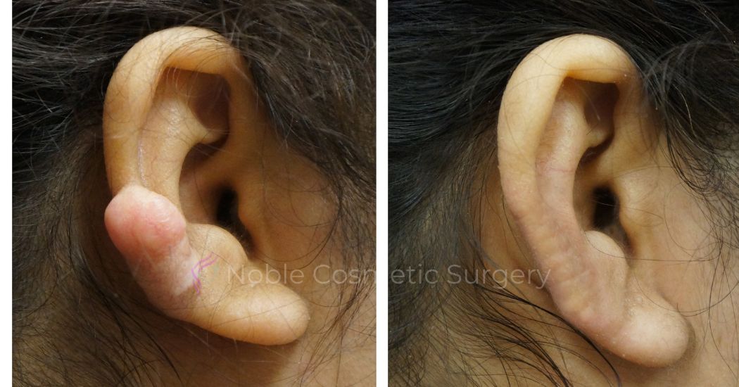 P1-00800E | Before and After Earlobe Repair 1