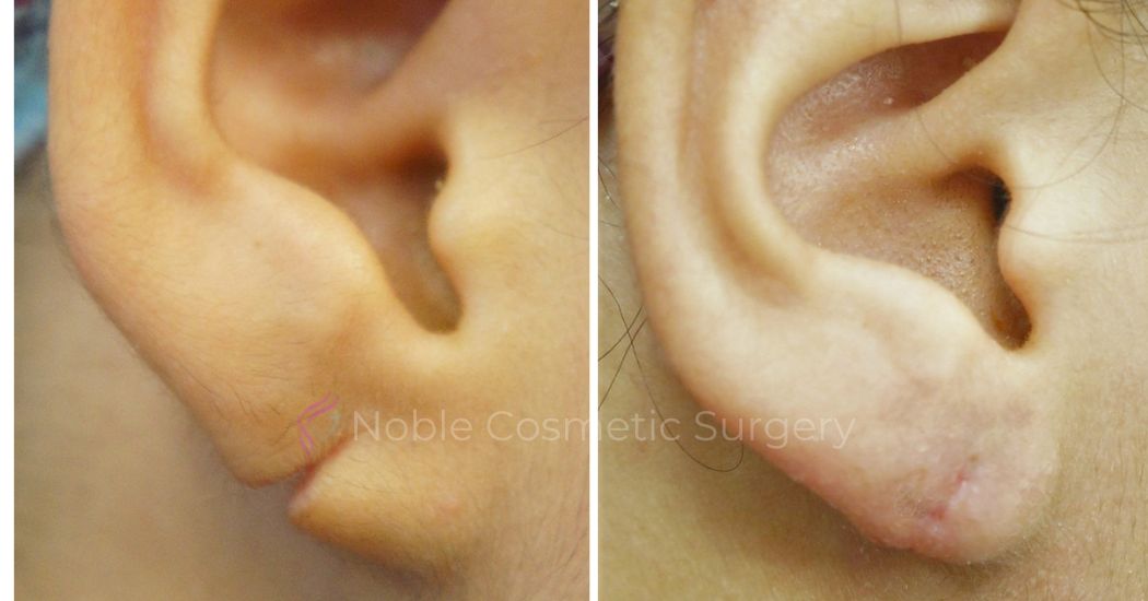 P3-00802E | Before and After Earlobe Repair 1