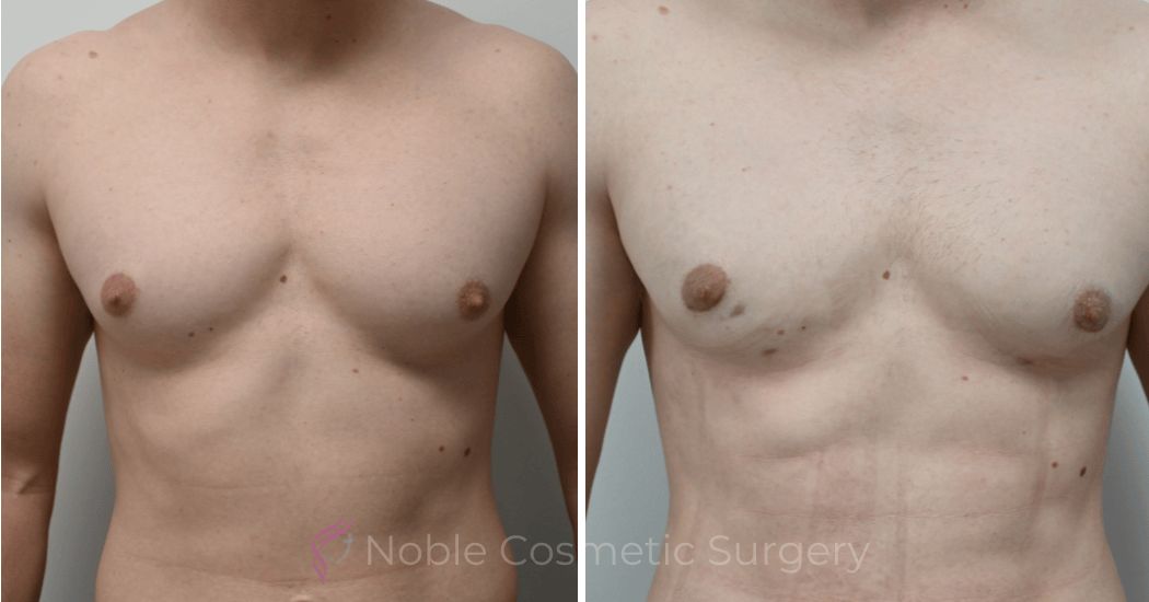P3-17230 | Before and After Gynecomastia 1