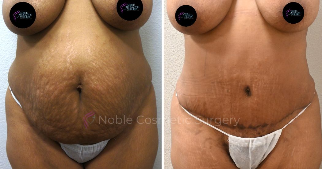 TUMMY-TUCK-CASE-00033 | Before and After Abdominoplasty 1