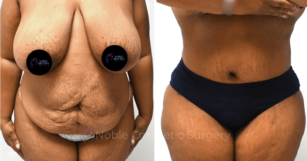 TUMMY-TUCK-CASE-14522 | Before and After Abdominoplasty 1