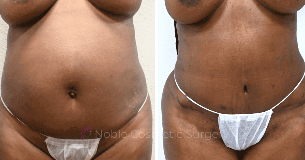 TUMMY-TUCK-CASE-13477 | Before and After Abdominoplasty 1