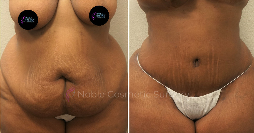 TUMMY-TUCK-CASE-00051 | Before and After Abdominoplasty 1