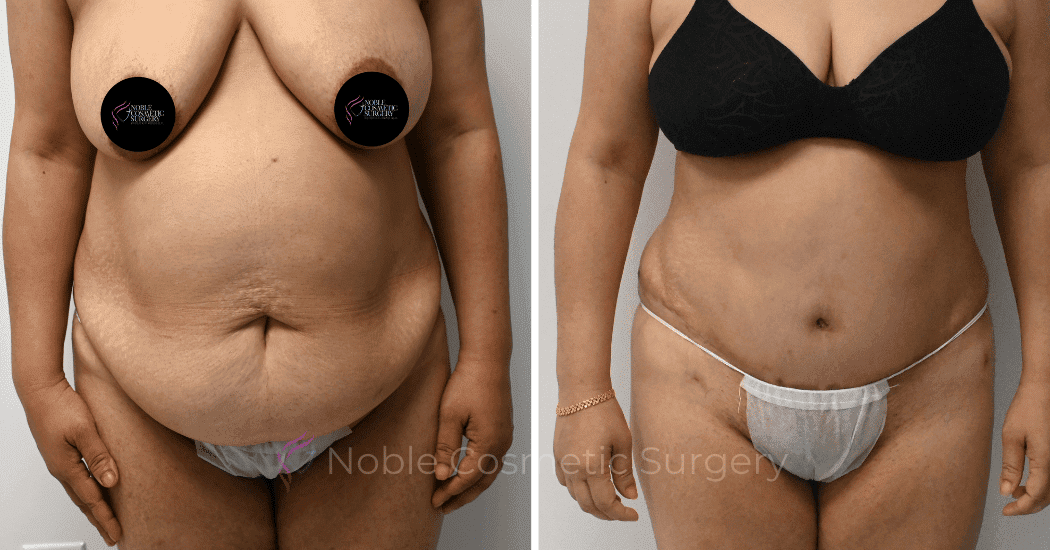 TUMMY-TUCK-CASE-11285 | Before and After Abdominoplasty 1