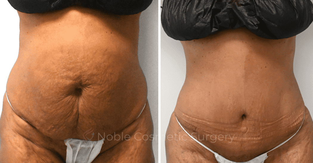 TUMMY-TUCK-CASE-10626 | Before and After Abdominoplasty 1
