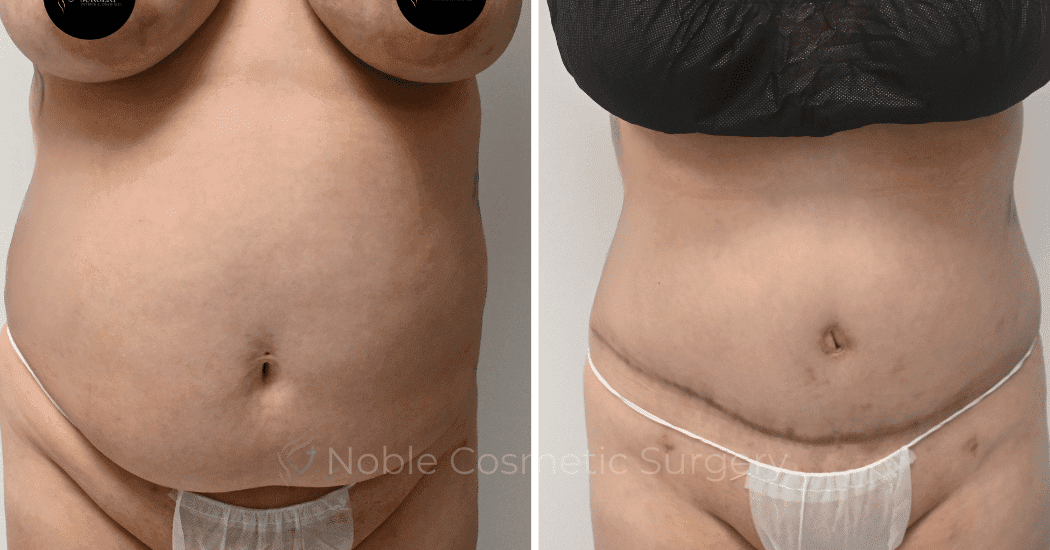 TUMMY-TUCK-CASE-10538 | Before and After Abdominoplasty 1