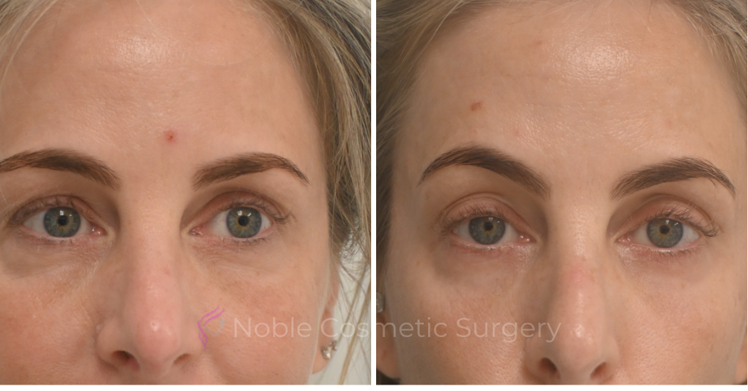 LIQUID-RHINOPLASTY-CASE-10007 | Before and After Liquid Rhinoplasty 1