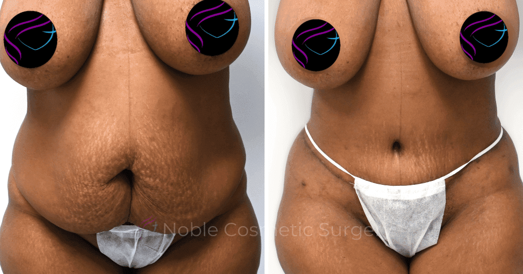 TUMMY-TUCK-CASE-14435 | Before and After Abdominoplasty 1