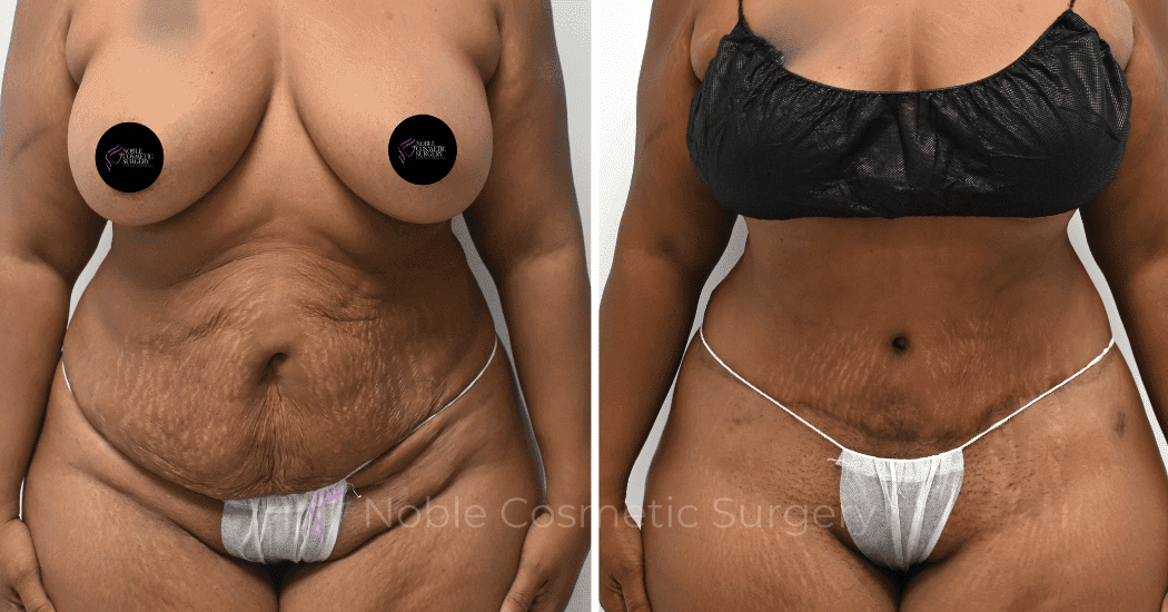 TUMMY-TUCK-CASE-14814 | Before and After Abdominoplasty 1
