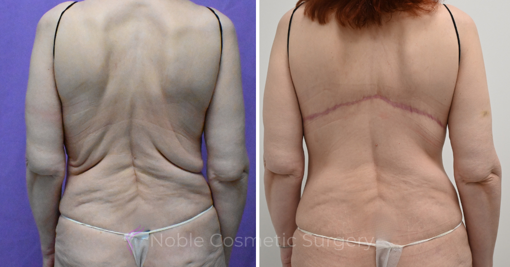 Case--12099 | Before and After Back Lift 1