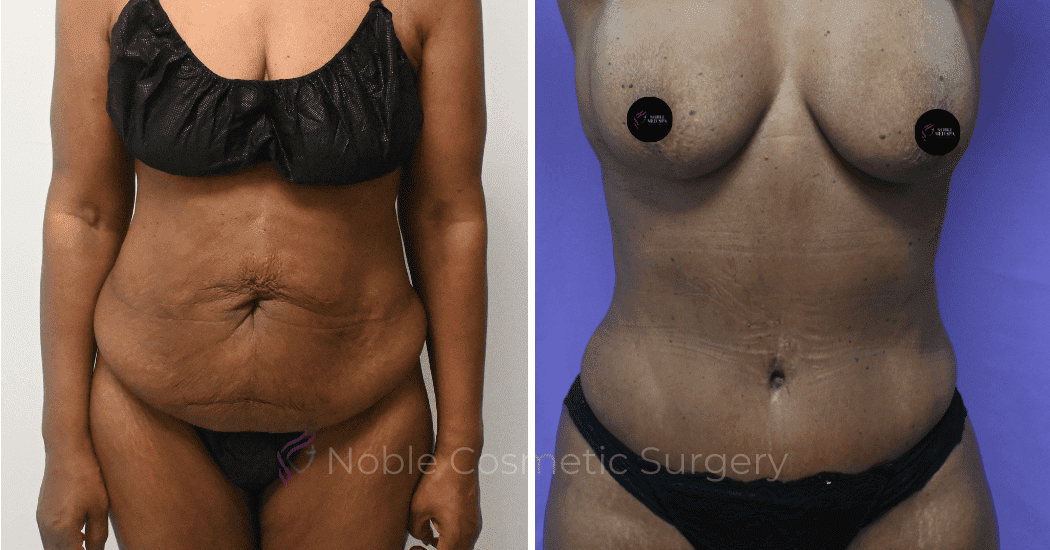 TUMMY-TUCK-CASE-10375 | Before and After Abdominoplasty 1