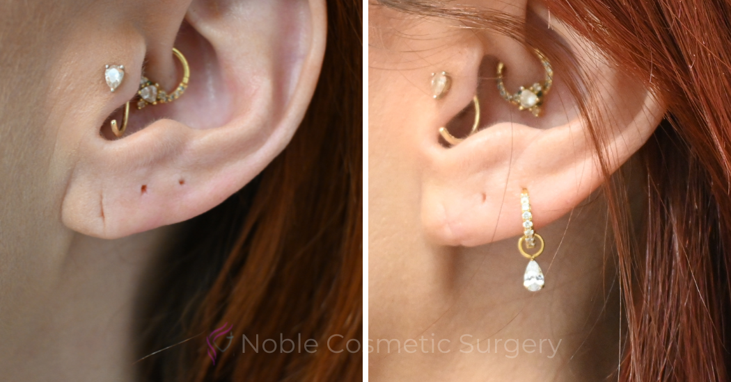 Case--20318 | Before and After Earlobe Repair 1