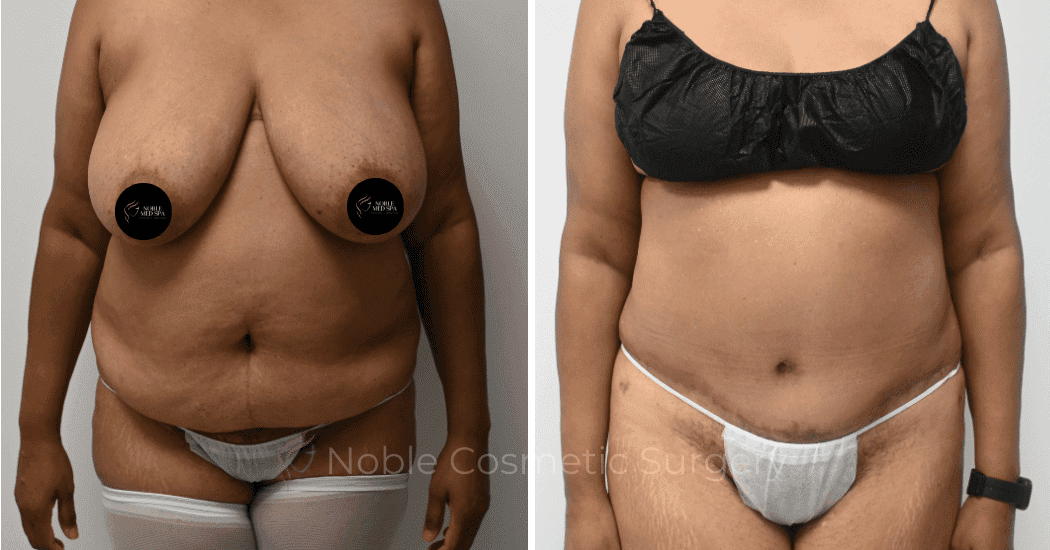 TUMMY-TUCK-CASE-11110 | Before and After Abdominoplasty 1