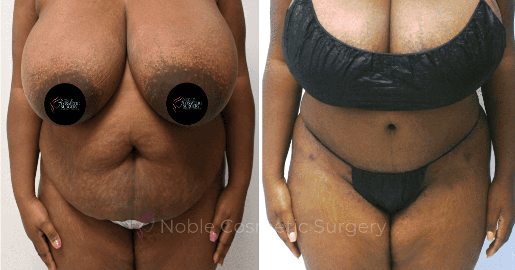TUMMY-TUCK-CASE-11720 | Before and After Abdominoplasty 1