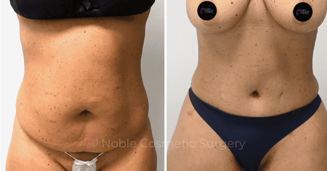 TUMMY-TUCK-CASE-10616 | Before and After Abdominoplasty 1