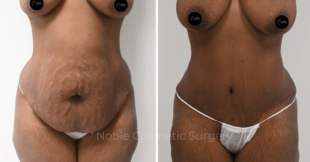 TUMMY-TUCK-CASE-10563 | Before and After Abdominoplasty 1