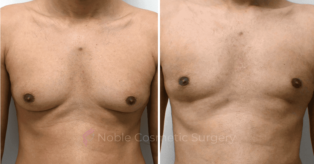GYNECOMASTIA-CASE-10707 | Before and After Gynecomastia 1