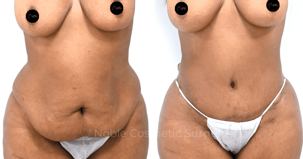 TUMMY-TUCK-CASE-13171 | Before and After Abdominoplasty 1