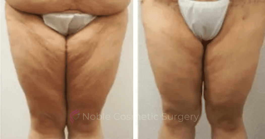 Thigh-Lift-Case-10386 | Before and After Thigh Lift 1