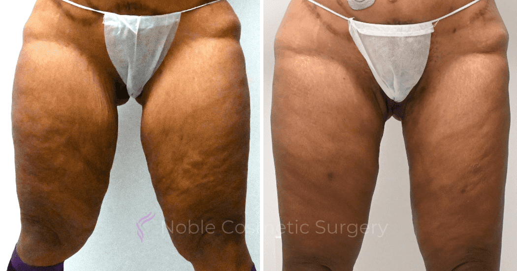 Thigh-Lift-Case-10384 | Before and After Thigh Lift 1