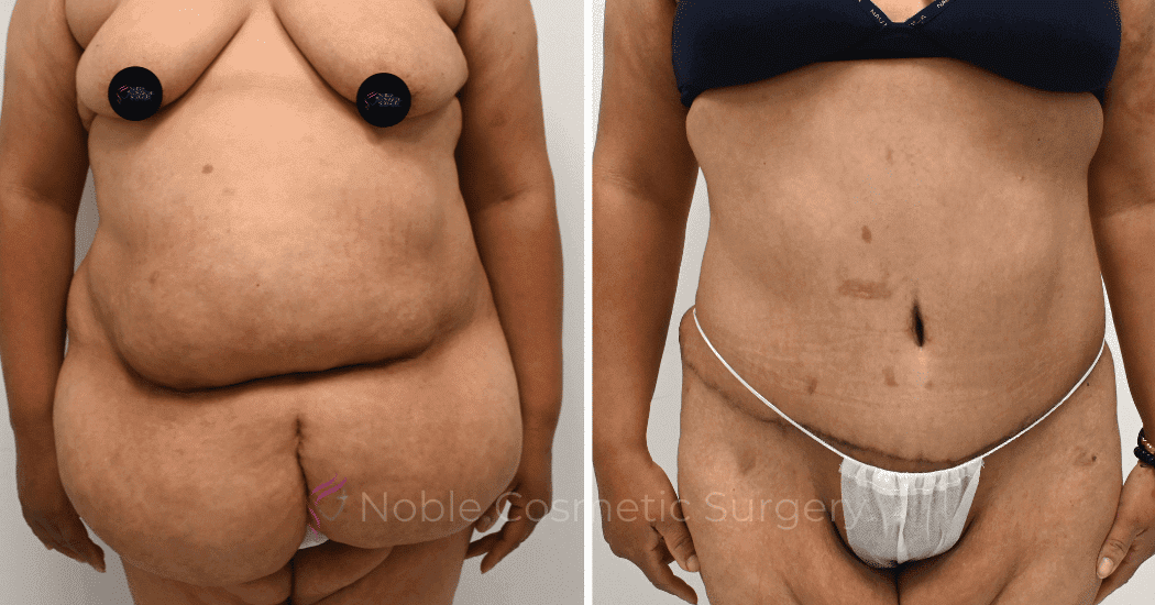 TUMMY-TUCK-CASE-12513 | Before and After Abdominoplasty 1