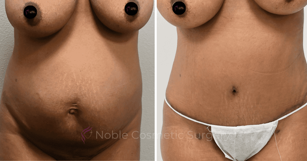 TUMMY-TUCK-CASE-14407 | Before and After Abdominoplasty 1