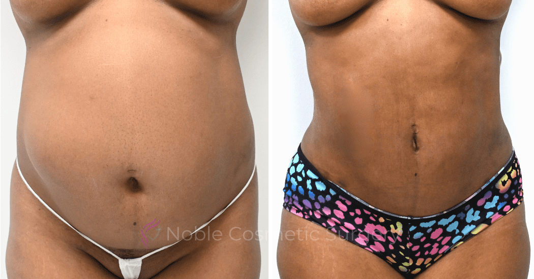 TUMMY-TUCK-CASE-00311 | Before and After Abdominoplasty 1