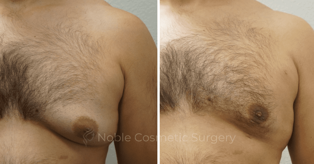GYNECOMASTIA--CASE-16730 | Before and After Gynecomastia 1