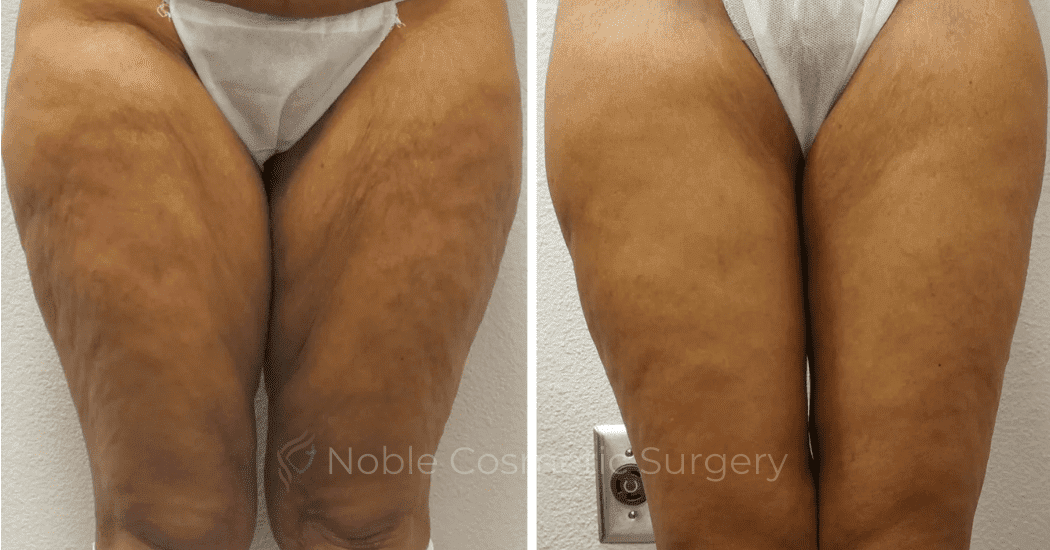 Thigh-Lift-Case-10385 | Before and After Thigh Lift 1