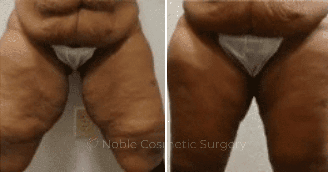 Thigh-Lift-Case-10389 | Before and After Thigh Lift 1