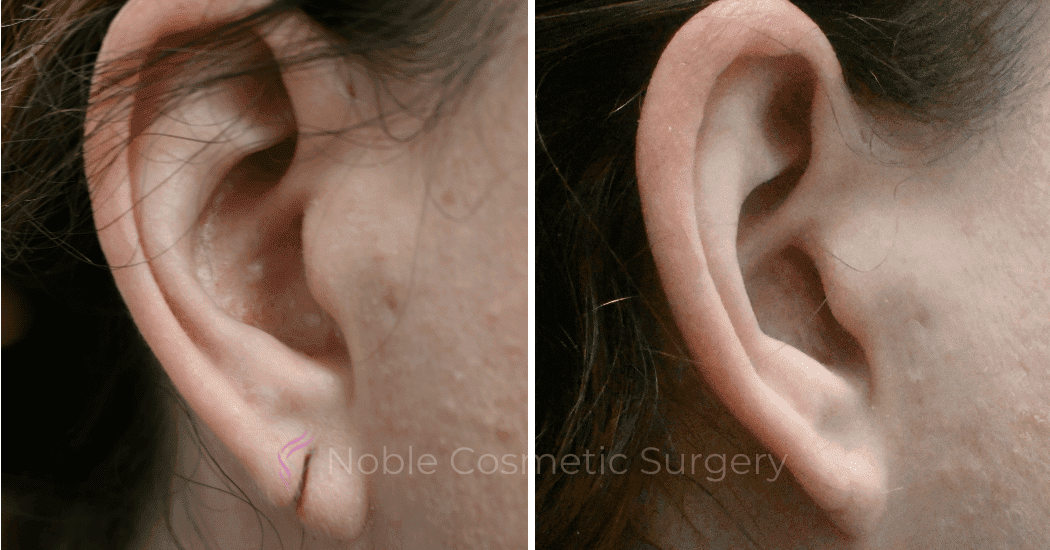 Earlobe-Repair-Case-20256 | Before and After Earlobe Repair 1