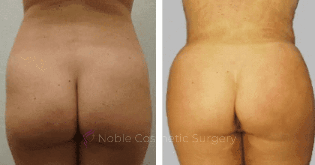 Brazilian-Butt-Lift-Case-15114 | Before and After Brazilian Butt Lift