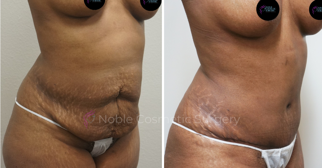 TUMMY-TUCK-CASE-00041 | Before and After Abdominoplasty 2