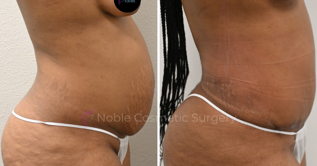 TUMMY-TUCK-CASE-00037 | Before and After Abdominoplasty 2