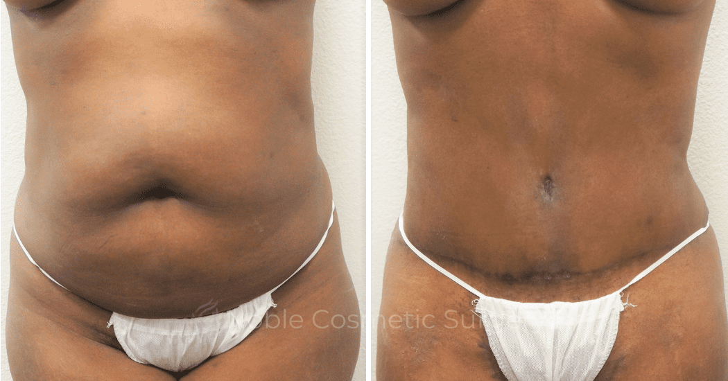 TUMMY-TUCK-CASE-00305 | Before and After Abdominoplasty