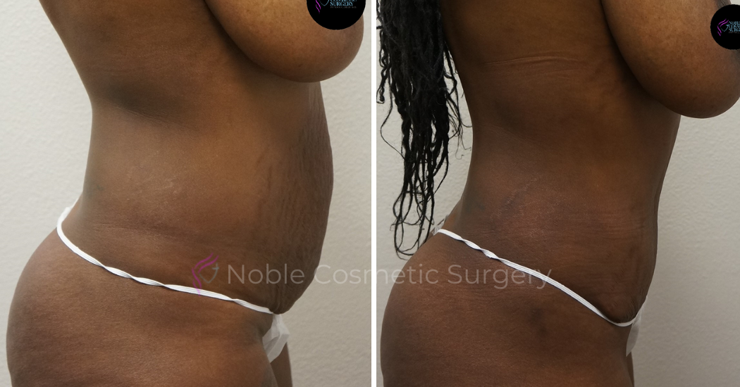 TUMMY-TUCK-CASE-00044 | Before and After Abdominoplasty 2