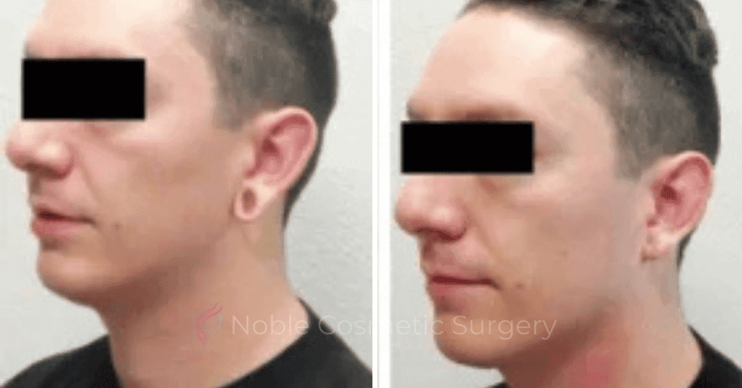 Earlobe-Repair-Case-20254 | Before and After Earlobe Repair 1
