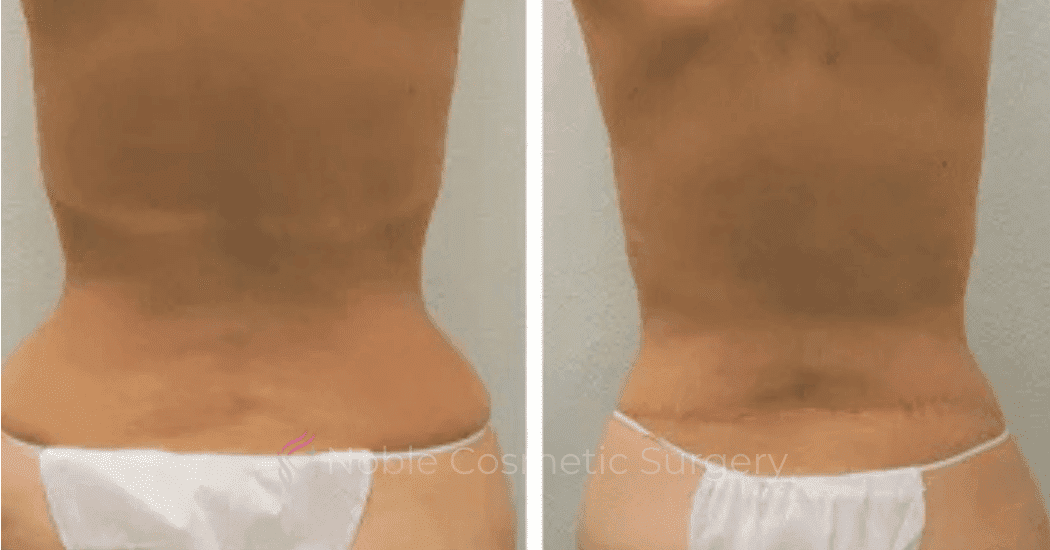 BACK-LIFT-CASE-00255 | Before and After Back Lift 1