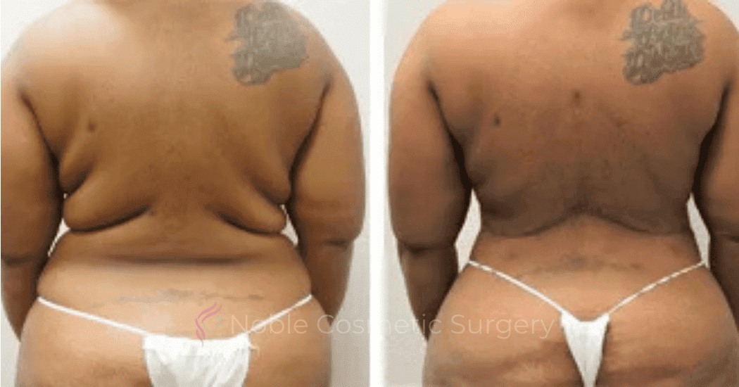 BACK-LIFT-CASE-00256 | Before and After Back Lift 1