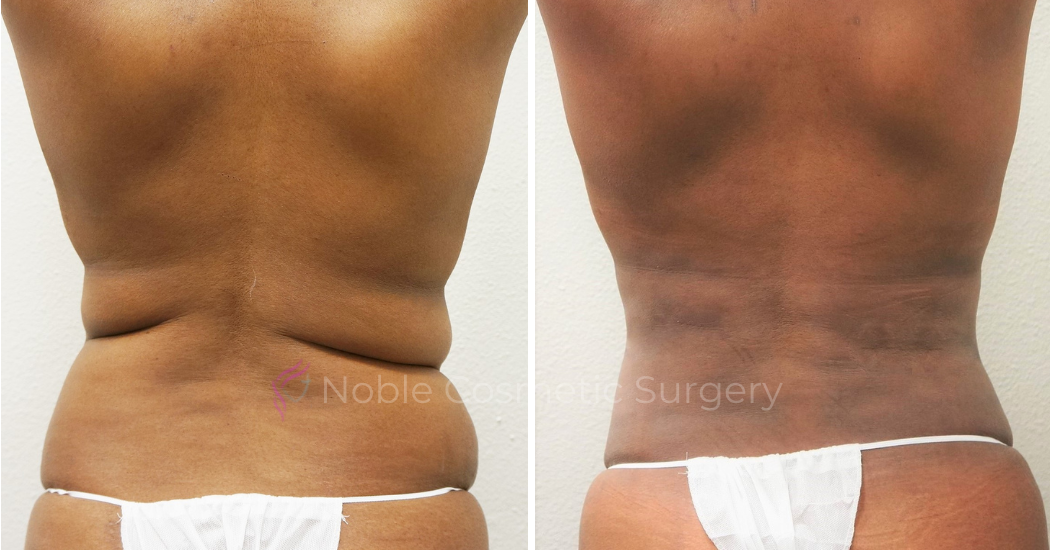 TUMMY-TUCK-CASE-00306 | Before and After Abdominoplasty 3