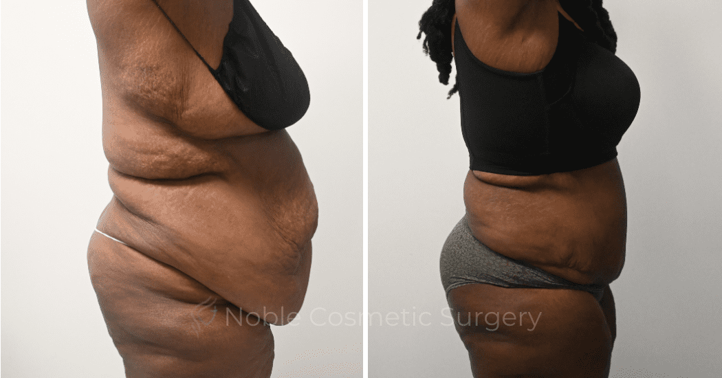 TUMMY-TUCK-CASE-00321 | Before and After Abdominoplasty 3