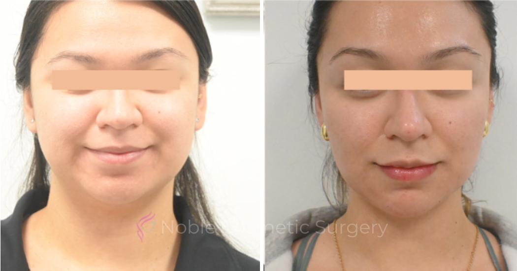 LIQUID-RHINOPLASTY-CASE-10006 | Before and After Liquid Rhinoplasty 1