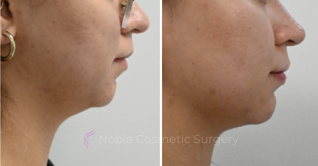 LIQUID-RHINOPLASTY-CASE-10005 | Before and After Liquid Rhinoplasty 1