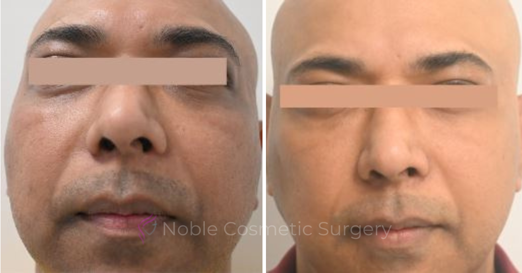 LIQUID-RHINOPLASTY-CASE-10003 | Before and After Liquid Rhinoplasty 1