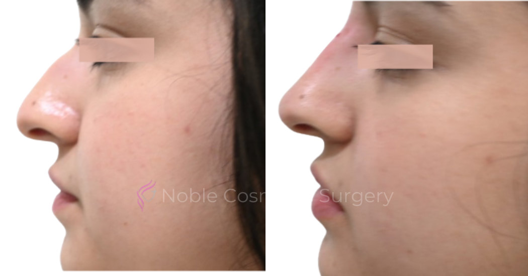 LIQUID-RHINOPLASTY-CASE-10002 | Before and After Liquid Rhinoplasty 1