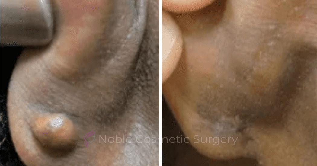 Earlobe-Repair-Case-20251 | Before and After Earlobe Repair 1