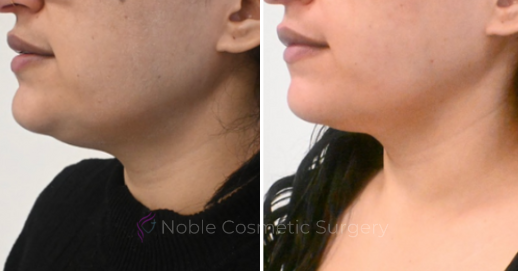 KYBELLA-CASE-00100 | Before and After Kybella 1