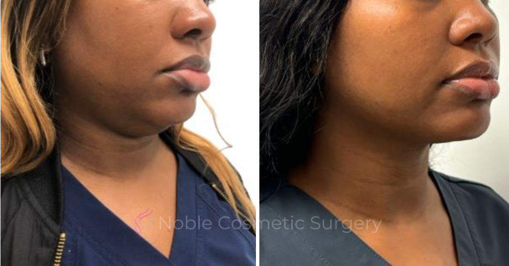 KYBELLA-CASE-00400 | Before and After Kybella 1