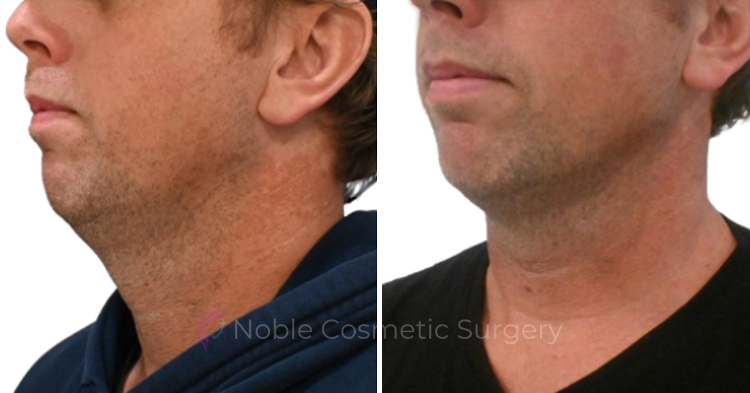 KYBELLA-CASE-00500 | Before and After Kybella 1