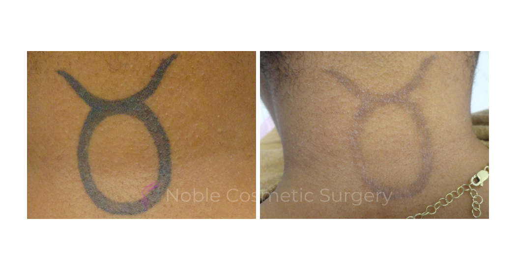 LASER-TATTOO-REMOVAL-CASE-00027 | Before and After Laser Tattoo Removal